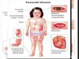 بیماری کاوازاکی تهدید برای کودکان