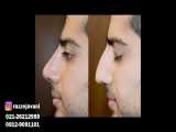 اصلاح قوز بینی و بالا اوردن نوک بینی در ۲۰ دقیقه بدون درد
