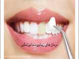 دندانپزشکی زیبایی ( ونیر ، لمینت ، کامپوزیت ، سرامیک )‌