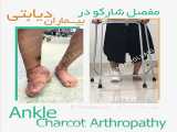 مفصل شارکو در بیماران دیابتی - Ankle charcot arthropathy