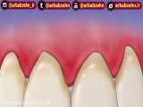 سابلیمینال زیبایی دندان (افزایش سفیدی ،ترمیم دندان و پوسیدگی)