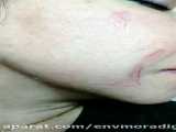 درمان جای زخم - اسکار زخم در مطب خانم دکتر پاکیده 02177877813