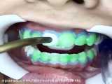 بلیچینگ دندان در کلینیک دندانپزشکی درسان - غرب تهران
