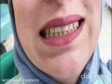 کامپوزیت ونیر در تهرانپارس | کلینیک دندانپزشکی ترنج
