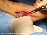 عمل جراحی بازسازی رباط مچ پا در ورزشکاران با استفاده از آلوگرافت