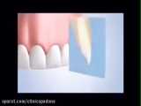 مقایسه دندان مصنوعی متحرک با بریج و ایمپلنت