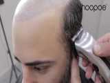 پروتز موی مردانه در مرکز زیبایی آقایان هوپو