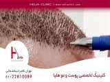 علت ریزش و پوسته های روی سر بعد از کاشت مو  | کلینیک هلیا | 02122810089