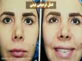 عمل ترمیم بینی  عالی توسط بهترین جراح ترمیمی در تهران دکتر امید ابراهیمی
