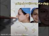 چهار ماه بعد از عمل بینی | جراح بینی خوب در تهران