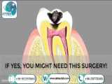 one-channel root canal re-treatment in atrina