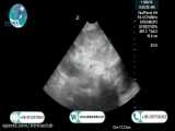 Transplanted kidney color Doppler ultrasound in atrina