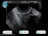 Ultrasound of the salivary glands (submandibular parotid)