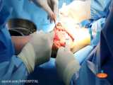 عمل جراحی تعویض مفصل زانو