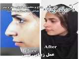 عمل زیبایی بینی توسط دکتر رجبی نژاد