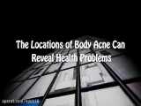 Causes of Severe Acne on 7 Different Locations of Body.webm