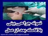 جراحی بینی با قوز و انحراف شدید بلافاصله بعد از عمل