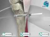 knee osteotomy in atrina