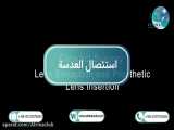 lensectomy  in atrina