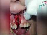 کشیدن و ایمپلنت همزمان دندان 
