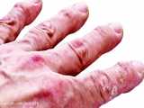 علل خشکی و اگزمای پوست دست و درمانهای موثر و بی ضرر خانگی