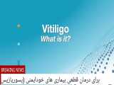 مایکل جکسون هم vitiligo داشت! روش درمانی ویتیلیگو