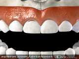 ترمیم دندان-مرکز دندانپزشکی فوق تخصصی ایمپلنت پردیس www.pardisdental.ir
