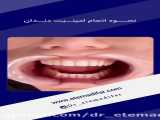 نحوه انجام لمینیت دندان . کلینیک دندانپزشکی دکتر روح الله اعتمادی فر بندرعباس