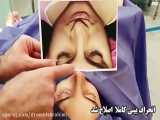 اصلاح انحراف شدید بینی توسط دکتر امید ابراهیمی بهترین جراح بینی در تهران