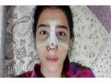 ویدیو ارسالی از مراجع عزیز دو ماه پس از جراحی زیبایی بینی توسط دکتر یحیوی