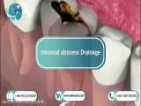 Intraoral abscess Drainage in atrina