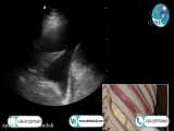Ultrasound of fluid search in pleura or ascites in atrina