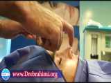 عمل ترمیمی افتادگی نوک بینی توسط دکتر امید ابراهیمی بهترین جراح ترمیم بینی در تهران 