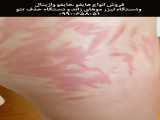 hifutreatment Right after the stretch marks treatment @eliot_beauty It will get