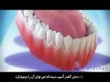 عمل کاشت ایمپلنت دندانی