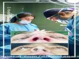 جراحی زیبایی بینی - دکتر سید هوتن علوی فوق تخصص جراحی پلاستیک