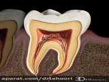 پوسیدگی دندانهای مجاور- دندانپزشکی فوق تخصصی ایمپلنت پردیس www.pardisdental.ir