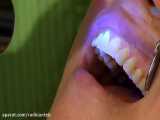 نشان دهنده پلاک دندان دایرکتا | Directa Plac O Tect