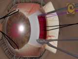 فیلم جراحی انحراف چشم به روش رسسشن 
