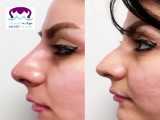 فرمدهی بینی با تزریق ژل-موگه کلینیک