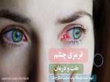 قرمزی چشم از دلیل تا روش درمان خانگی