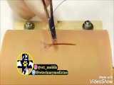 آموزش بخیه کوشینگ cushing suture pattern