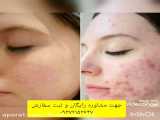 درمان چین وچروک های صورت با کرم لازان(کلاژن سازی، جوانسازی پوست)