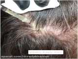 تزریق PRP جهت درمان قطعی ریزش مو
