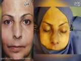 عمل زیبایی بینی با انحراف شدید توسط دکتر امید ابراهیمی بهترین جراح بینی در تهران
