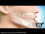 عقب بردن فک پایین | کلینیک دندانپزشکی ترنج