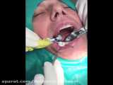 ایمپلنت یک واحد دندان فک پایین