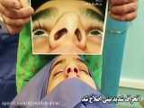 عمل انحراف شدید بینی توسط دکتر امید ابراهیمی بهترین جراح انحراف بینی در تهران