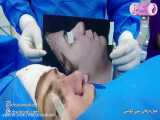 عمل جراحی بینی گوشتی