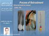درمان مجدد،مراحل کلینیکی در کیسهای ساده ( دکتر شنتیایی)